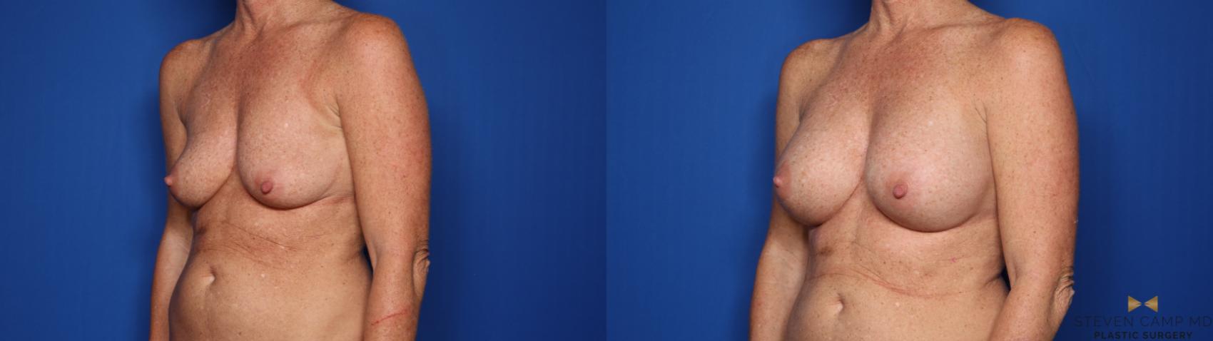 Before & After Breast Augmentation Case 424 Left Oblique View in Fort Worth & Arlington, Texas