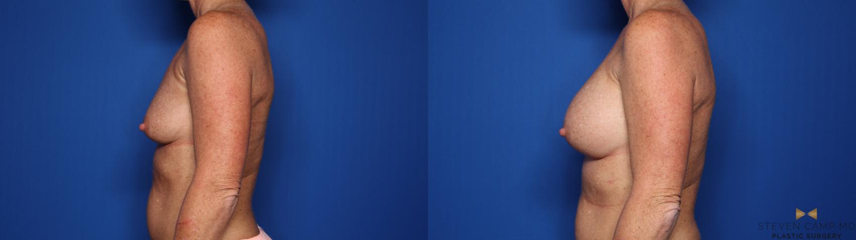 Before & After Breast Augmentation Case 424 Left Side View in Fort Worth & Arlington, Texas