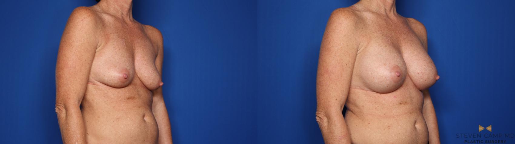 Before & After Breast Augmentation Case 424 Right Oblique View in Fort Worth & Arlington, Texas