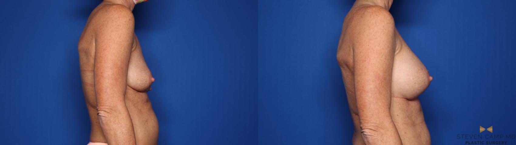 Before & After Breast Augmentation Case 424 Right Side View in Fort Worth & Arlington, Texas
