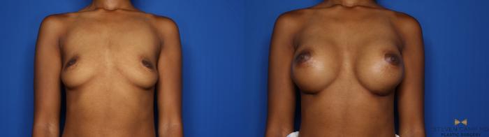 Before & After Breast Augmentation Case 425 Front View in Fort Worth & Arlington, Texas
