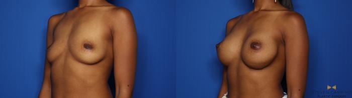 Before & After Breast Augmentation Case 425 Left Oblique View in Fort Worth & Arlington, Texas