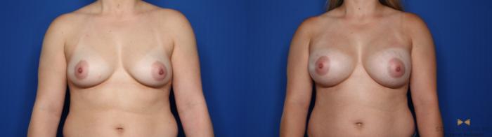 Before & After Breast Augmentation Case 426 Front View in Fort Worth & Arlington, Texas