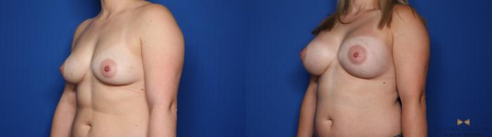 Before & After Breast Augmentation Case 426 Left Oblique View in Fort Worth & Arlington, Texas