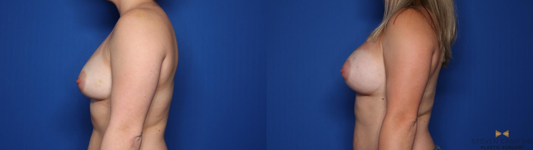 Before & After Breast Augmentation Case 426 Left Side View in Fort Worth & Arlington, Texas
