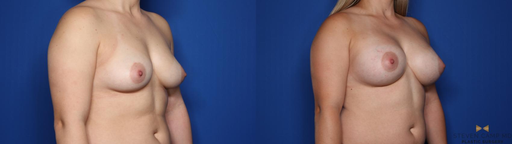 Before & After Breast Augmentation Case 426 Right Oblique View in Fort Worth & Arlington, Texas