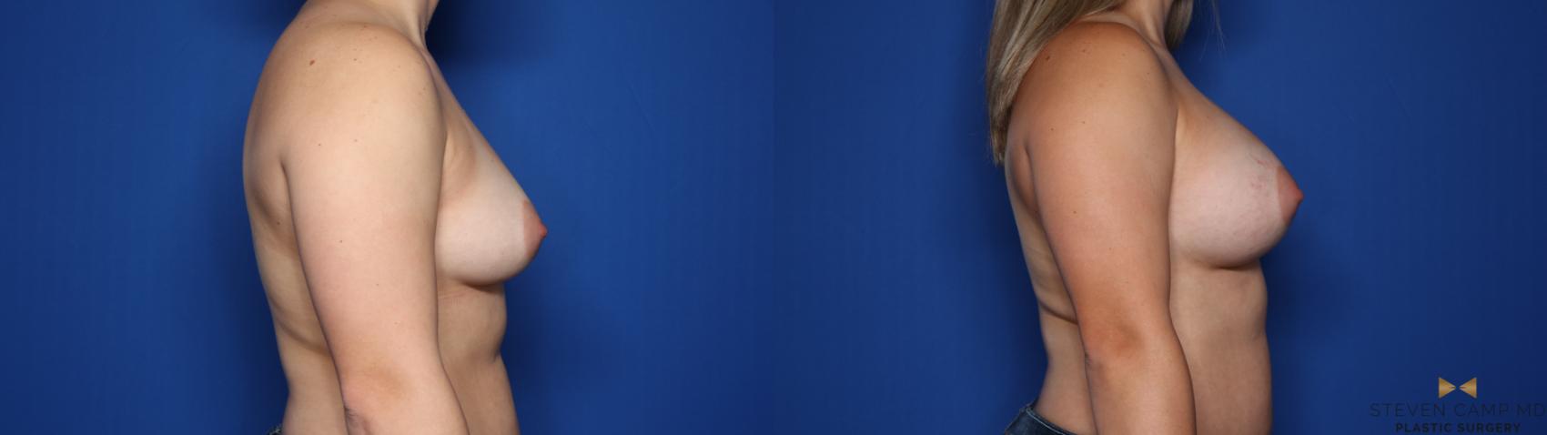 Before & After Breast Augmentation Case 426 Right Side View in Fort Worth & Arlington, Texas