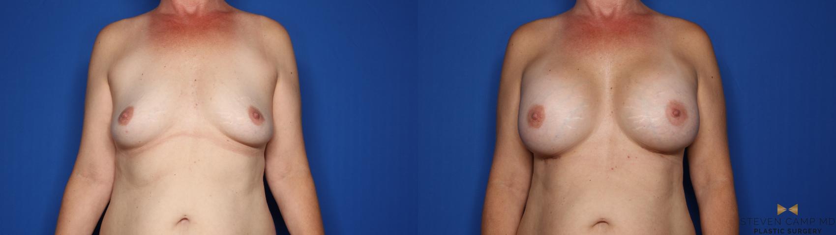 Before & After Breast Augmentation Case 428 Front View in Fort Worth & Arlington, Texas