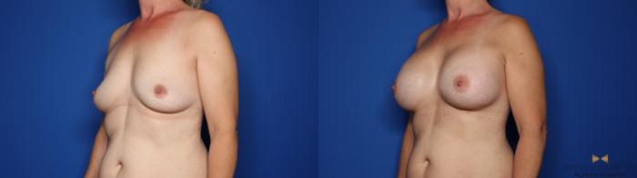 Before & After Breast Augmentation Case 428 Left Oblique View in Fort Worth & Arlington, Texas