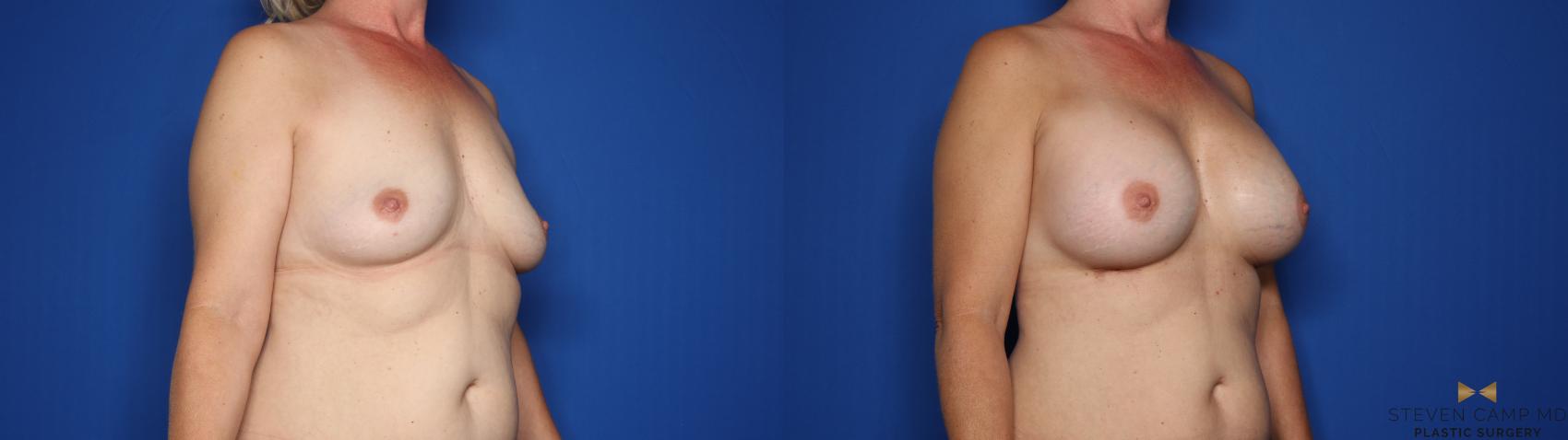 Before & After Breast Augmentation Case 428 Right Oblique View in Fort Worth & Arlington, Texas
