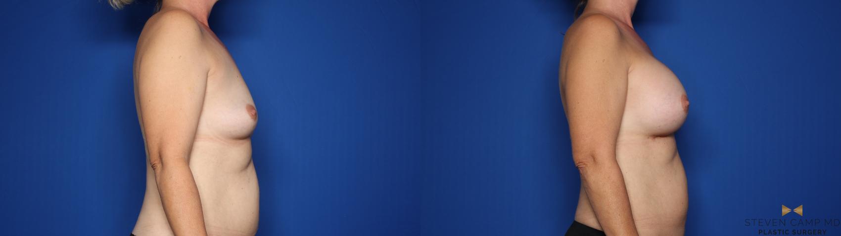 Before & After Breast Augmentation Case 428 Right Side View in Fort Worth & Arlington, Texas