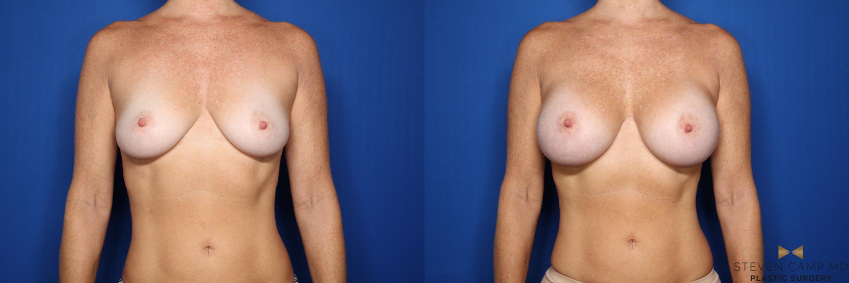 Before & After Breast Augmentation Case 436 Front View in Fort Worth, Texas