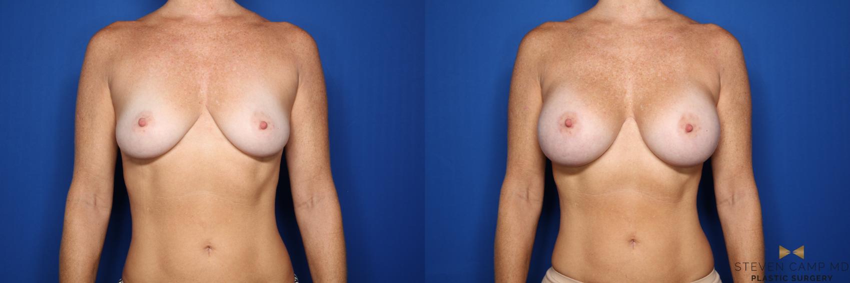 Before & After Breast Augmentation Case 436 Front View in Fort Worth & Arlington, Texas