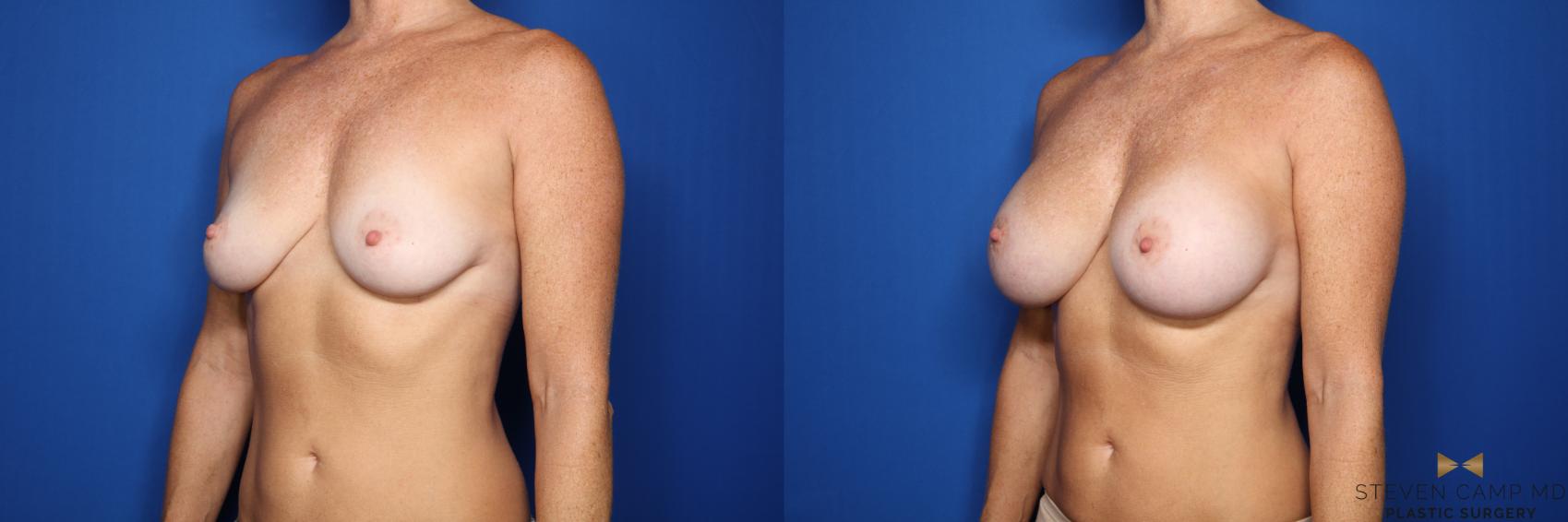 Before & After Breast Augmentation Case 436 Left Oblique View in Fort Worth & Arlington, Texas