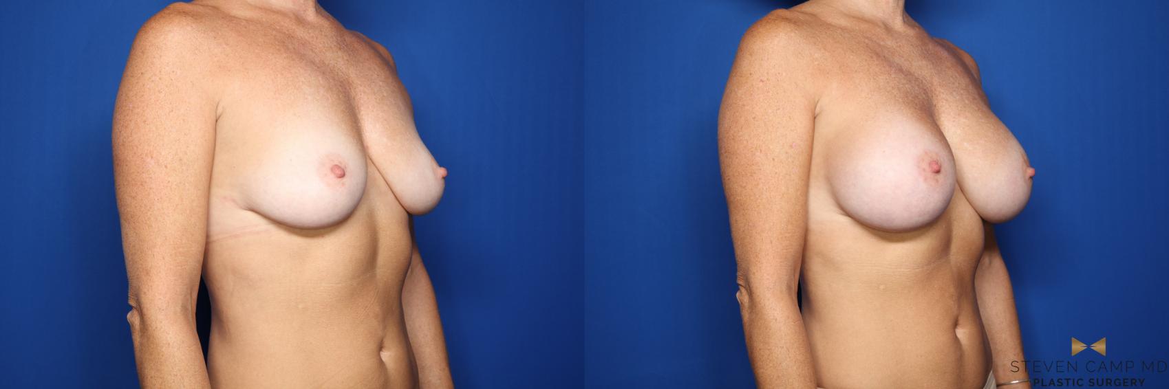 Before & After Breast Augmentation Case 436 Right Oblique View in Fort Worth & Arlington, Texas