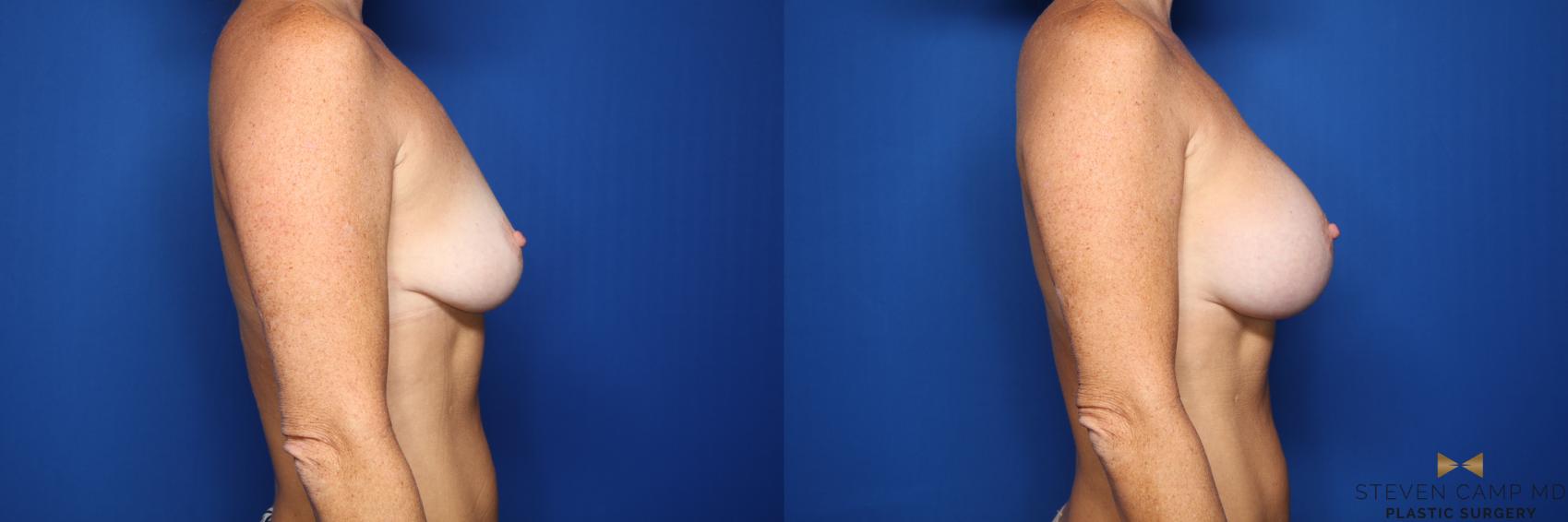 Before & After Breast Augmentation Case 436 Right Side View in Fort Worth, Texas