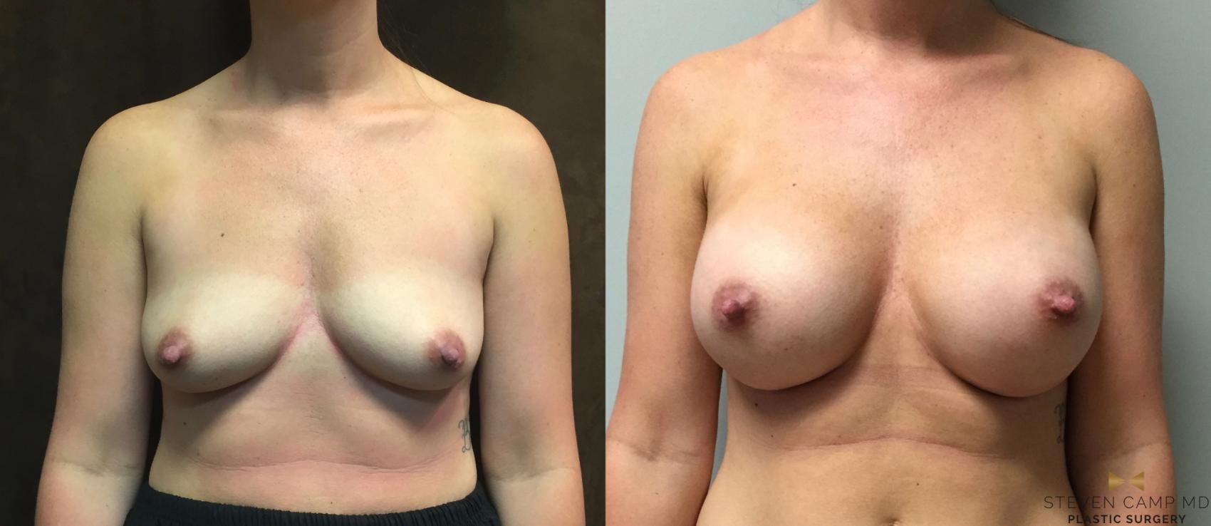 Before & After Breast Augmentation Case 44 View #1 View in Fort Worth, Texas