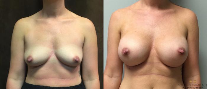 Before & After Breast Augmentation Case 44 View #1 View in Fort Worth & Arlington, Texas