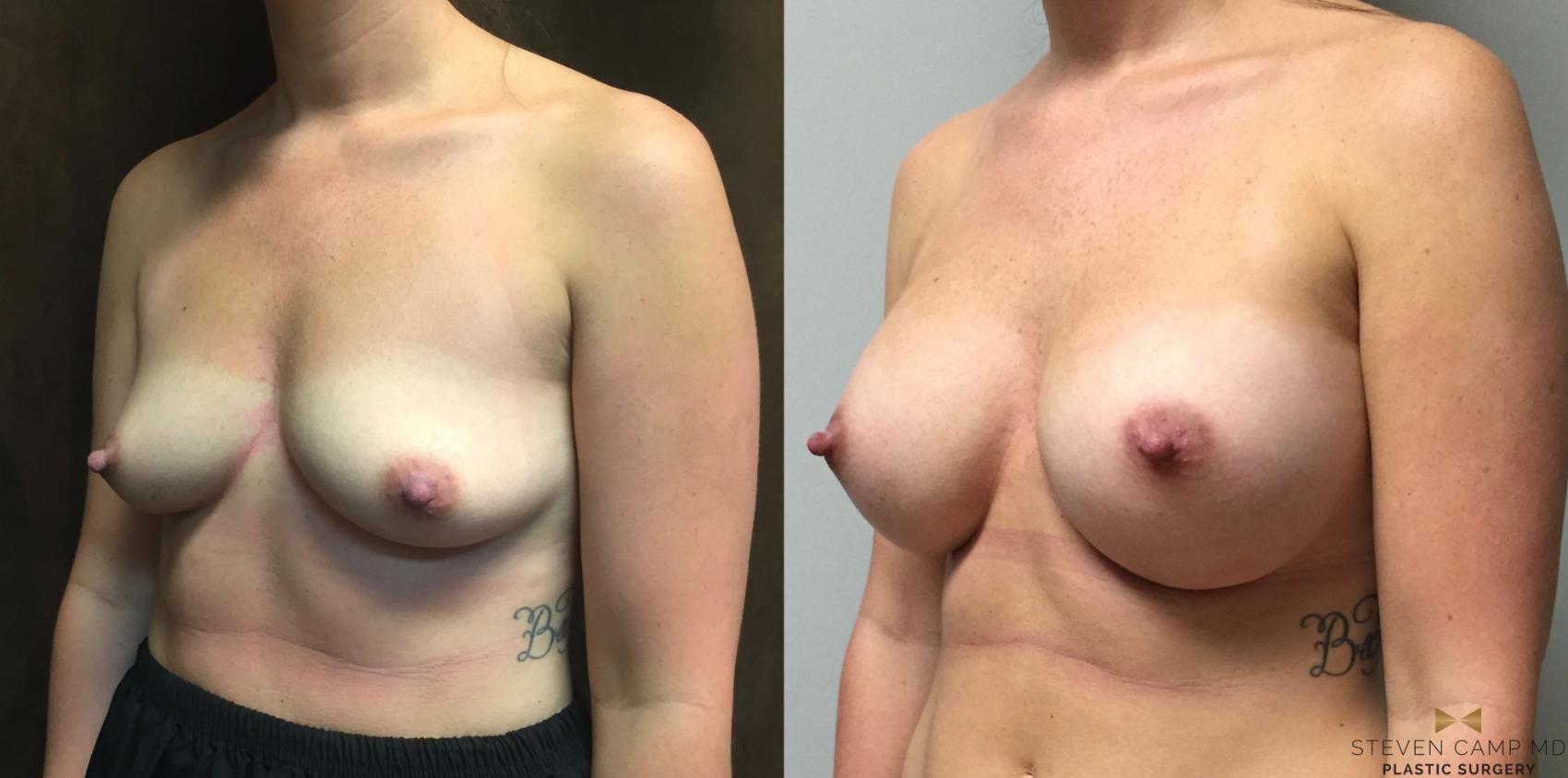 Before & After Breast Augmentation Case 44 View #2 View in Fort Worth, Texas