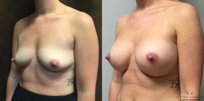 Before & After Breast Augmentation Case 44 View #2 View in Fort Worth & Arlington, Texas