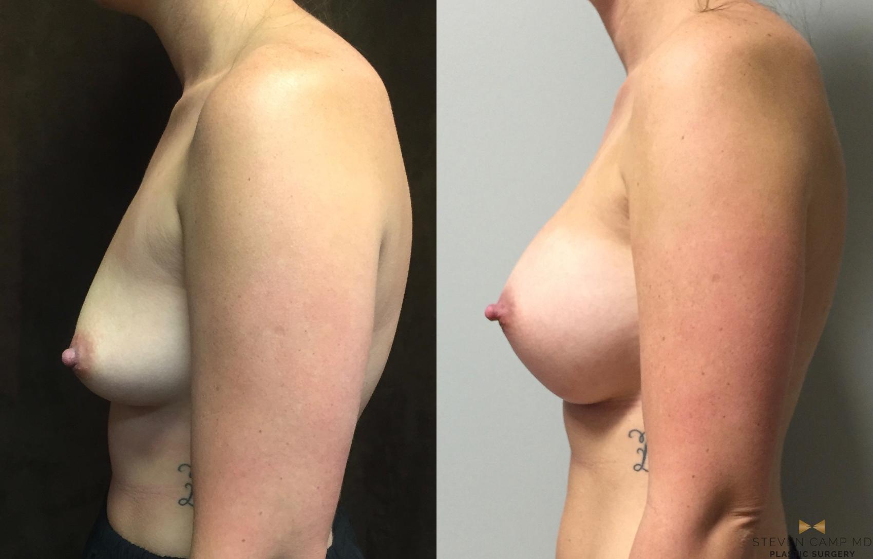 Before & After Breast Augmentation Case 44 View #3 View in Fort Worth, Texas