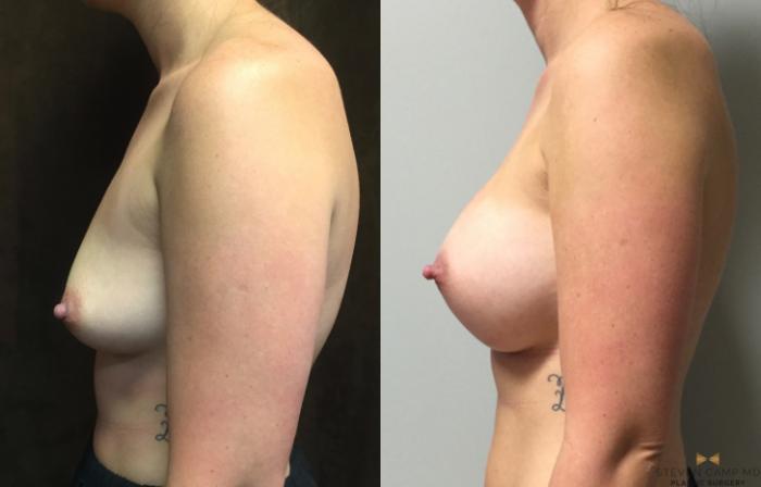 Before & After Breast Augmentation Case 44 View #3 View in Fort Worth & Arlington, Texas