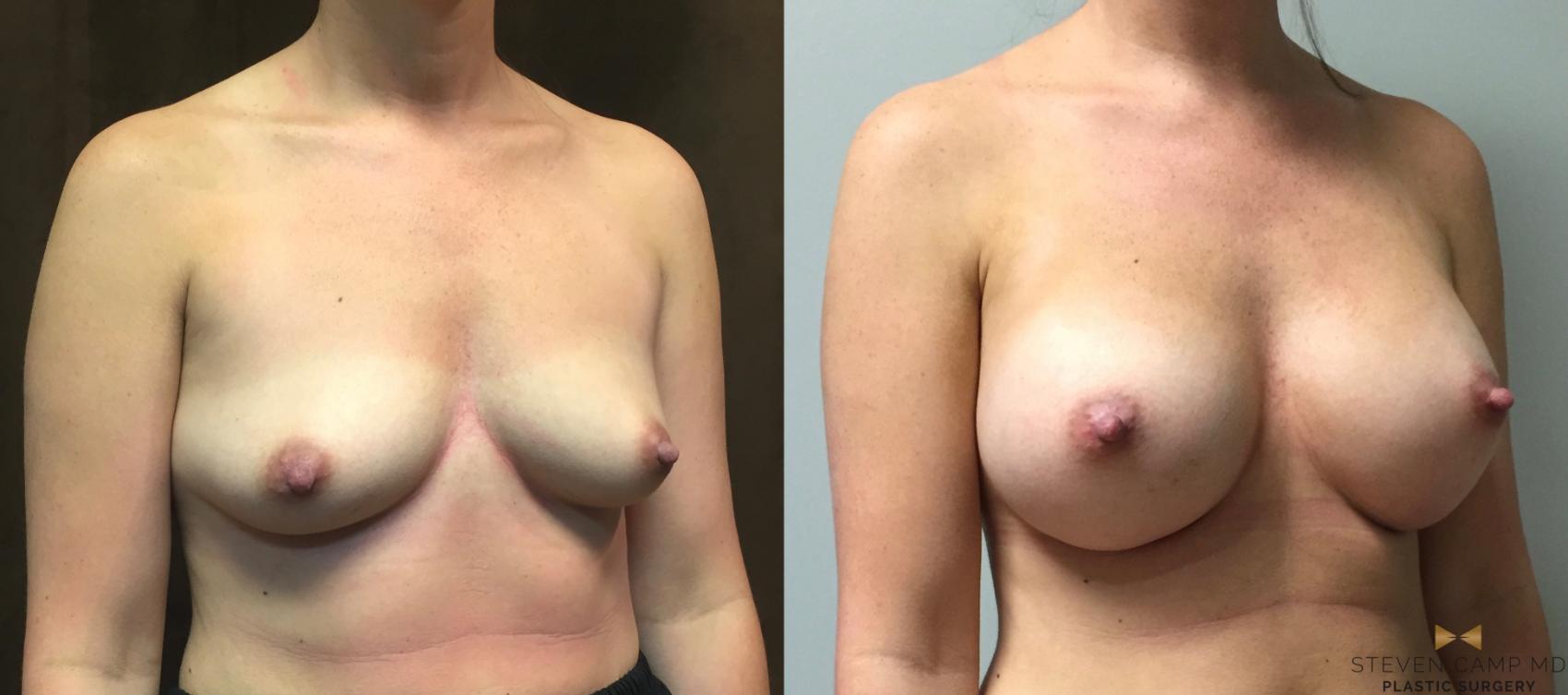 Before & After Breast Augmentation Case 44 View #4 View in Fort Worth, Texas