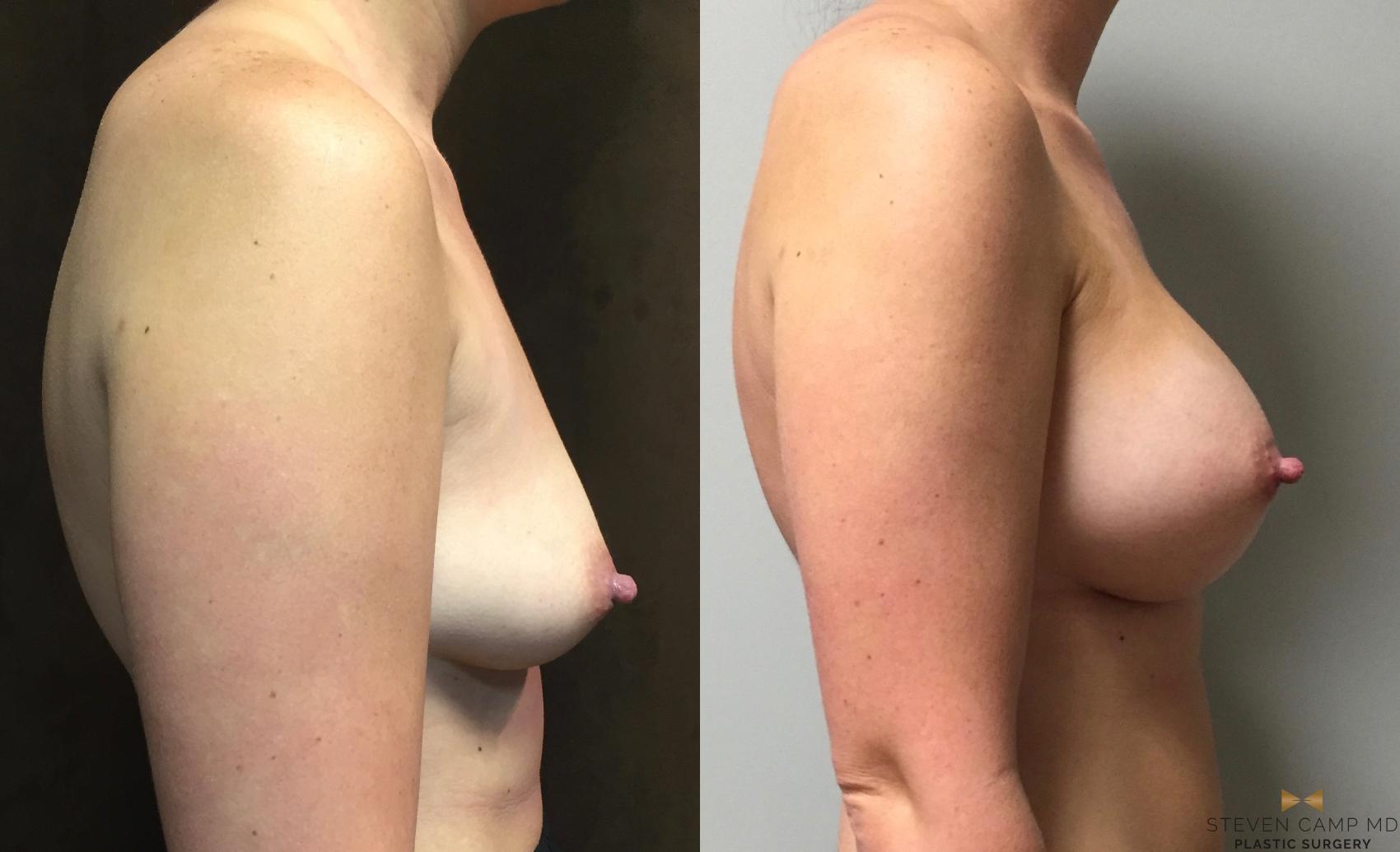 Before & After Breast Augmentation Case 44 View #5 View in Fort Worth, Texas