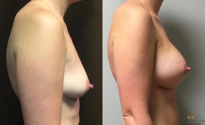 Before & After Breast Augmentation Case 44 View #5 View in Fort Worth & Arlington, Texas
