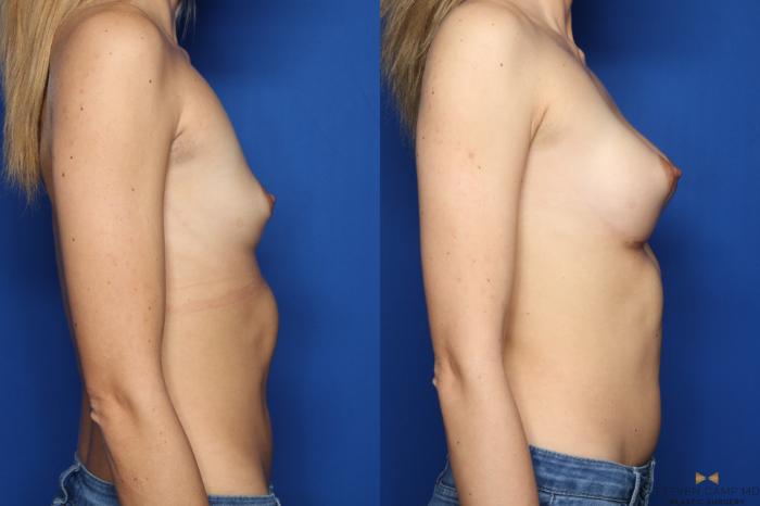 Before & After Breast Augmentation Case 440 Right Side View in Fort Worth & Arlington, Texas
