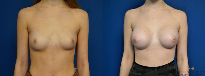 Before & After Breast Augmentation Case 442 Front View in Fort Worth, Texas