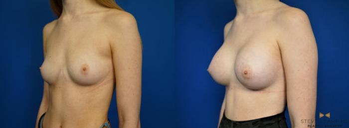 Before & After Breast Augmentation Case 442 Left Oblique View in Fort Worth, Texas