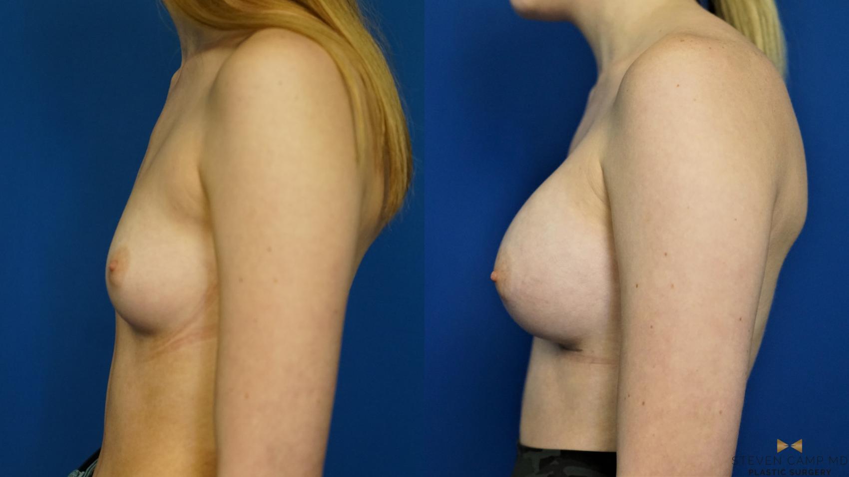 Before & After Breast Augmentation Case 442 Left Side View in Fort Worth & Arlington, Texas