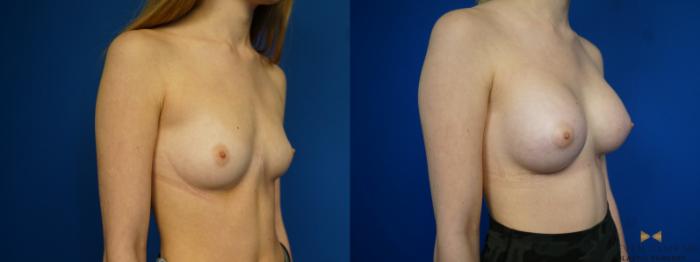 Before & After Breast Augmentation Case 442 Right Oblique View in Fort Worth, Texas