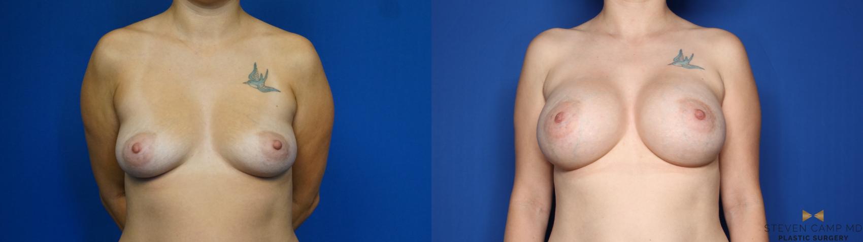 Before & After Breast Augmentation Case 444 Front View in Fort Worth, Texas