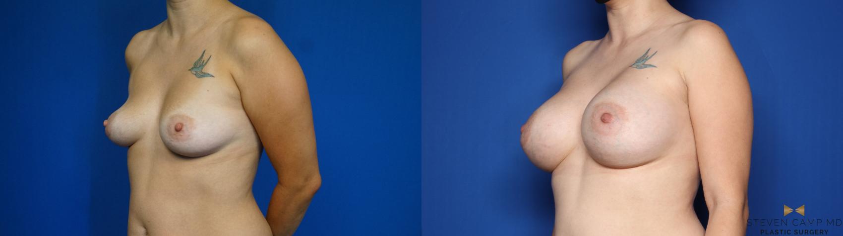 Before & After Breast Augmentation Case 444 Left Oblique View in Fort Worth & Arlington, Texas