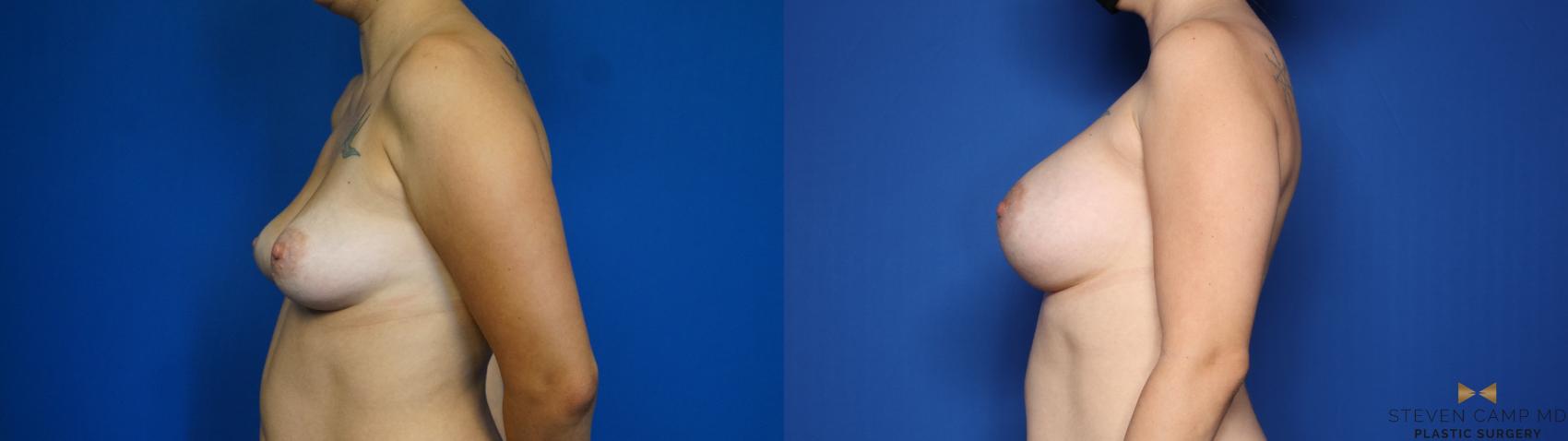 Before & After Breast Augmentation Case 444 Left Side View in Fort Worth & Arlington, Texas