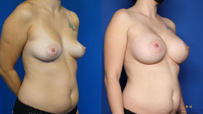 Before & After Breast Augmentation Case 444 Right Oblique View in Fort Worth & Arlington, Texas