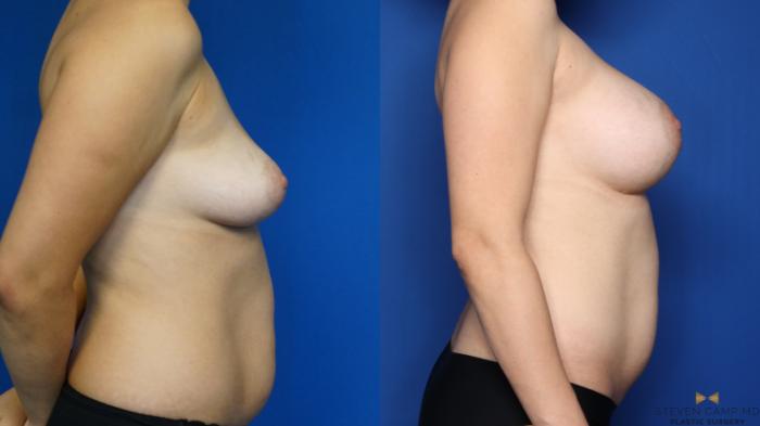 Before & After Breast Augmentation Case 444 Right Side View in Fort Worth, Texas