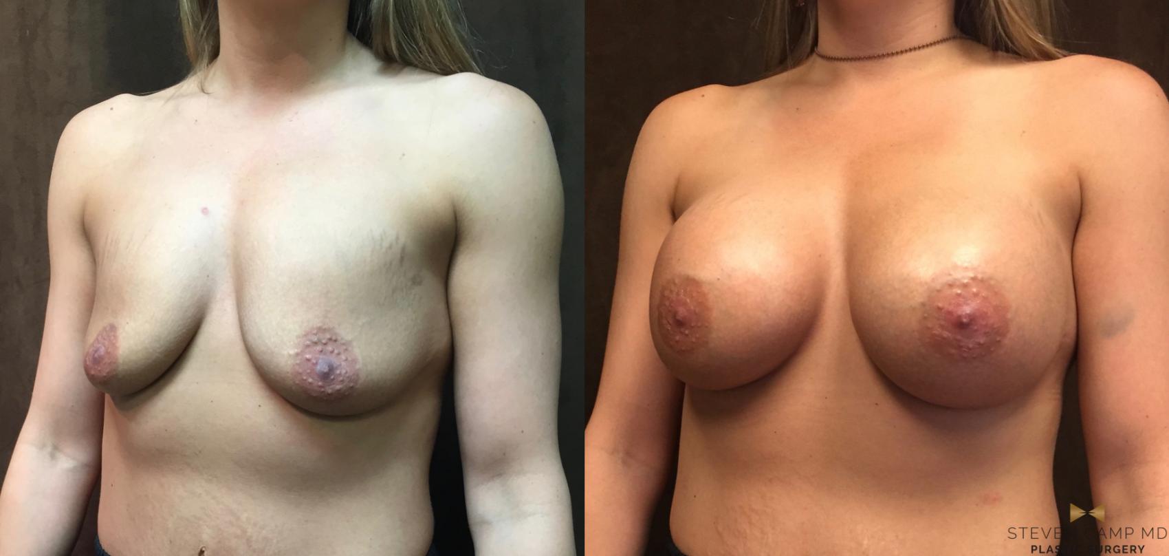 Before & After Breast Augmentation Case 45 View #2 View in Fort Worth, Texas