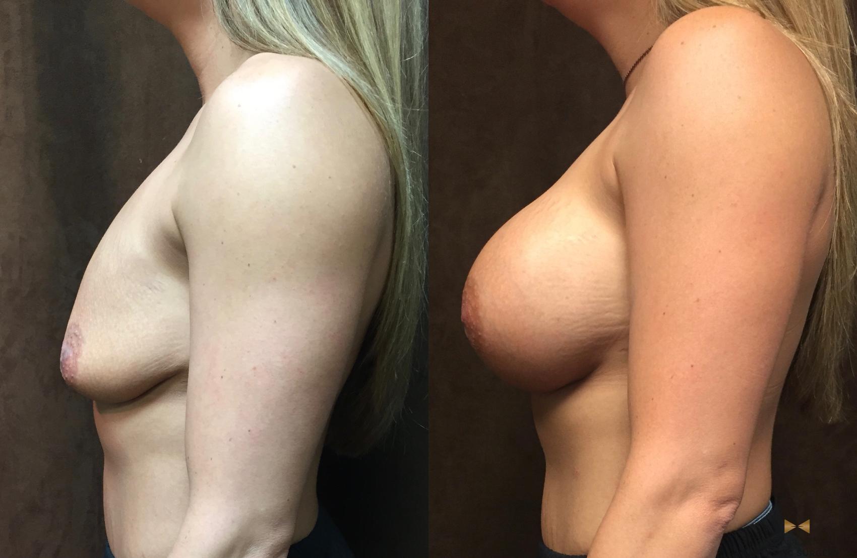 Before & After Breast Augmentation Case 45 View #3 View in Fort Worth, Texas