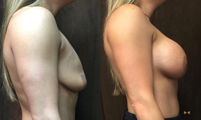 Before & After Breast Augmentation Case 45 View #5 View in Fort Worth, Texas