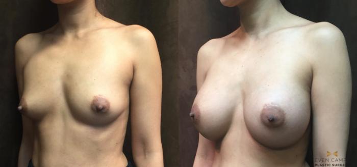 Before & After Breast Augmentation Case 46 View #2 View in Fort Worth, Texas