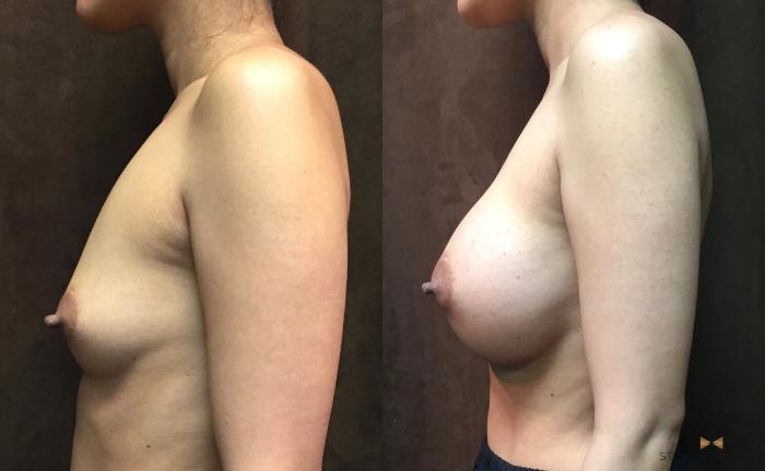 Before & After Breast Augmentation Case 46 View #3 View in Fort Worth, Texas