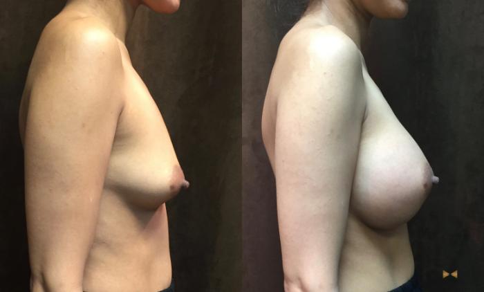 Before & After Breast Augmentation Case 46 View #5 View in Fort Worth, Texas