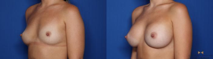 Before & After Breast Augmentation Case 464 Left Oblique View in Fort Worth, Texas