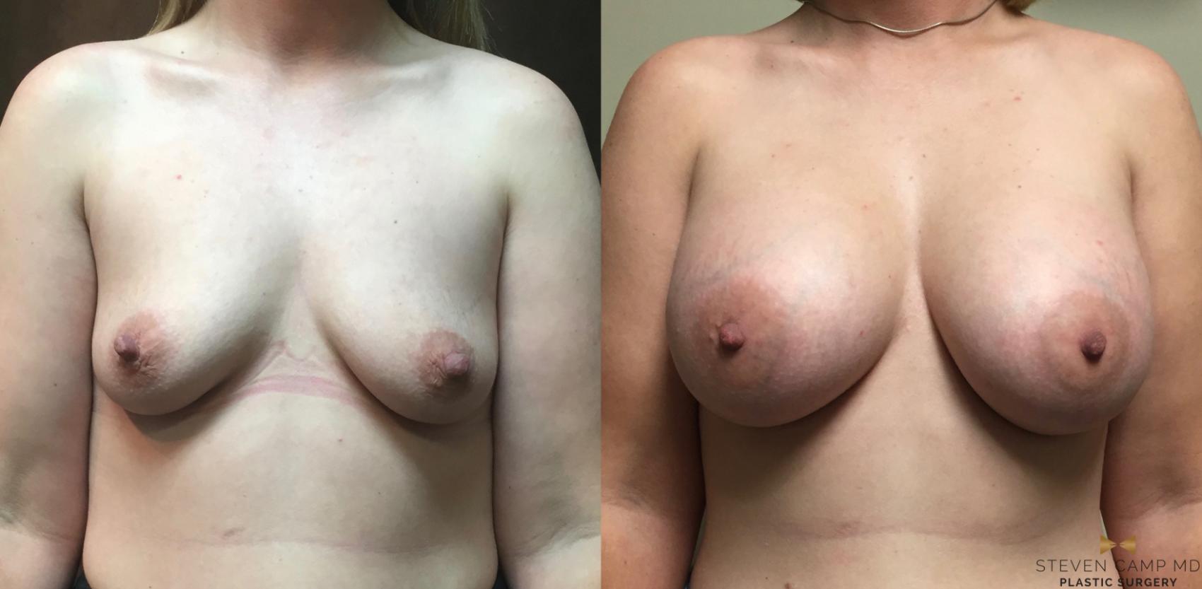 Before & After Breast Augmentation Case 47 View #1 View in Fort Worth, Texas