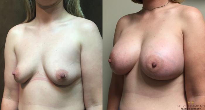 Before & After Breast Augmentation Case 47 View #2 View in Fort Worth, Texas