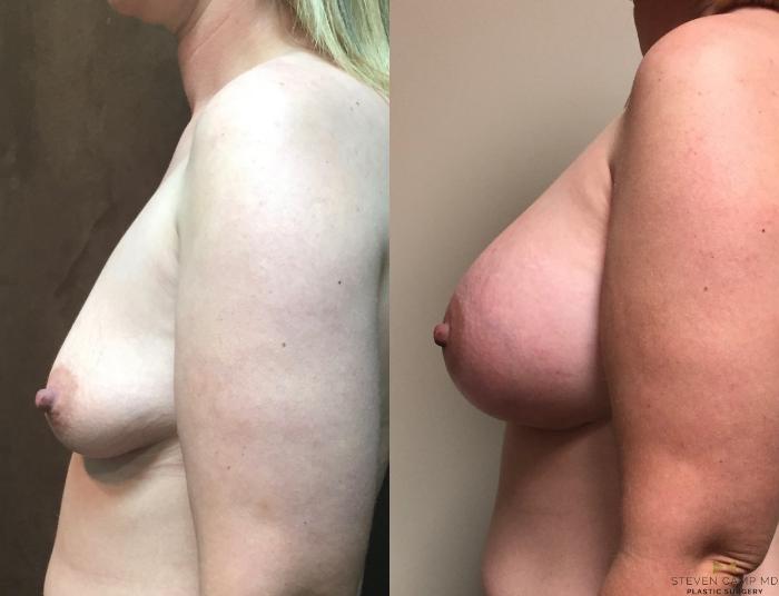 Before & After Breast Augmentation Case 47 View #3 View in Fort Worth, Texas