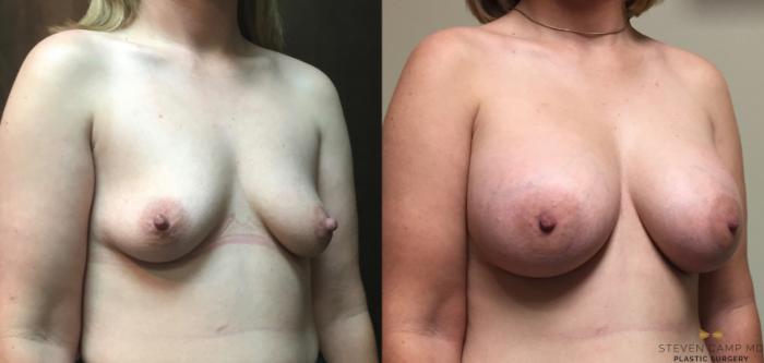 Before & After Breast Augmentation Case 47 View #4 View in Fort Worth, Texas